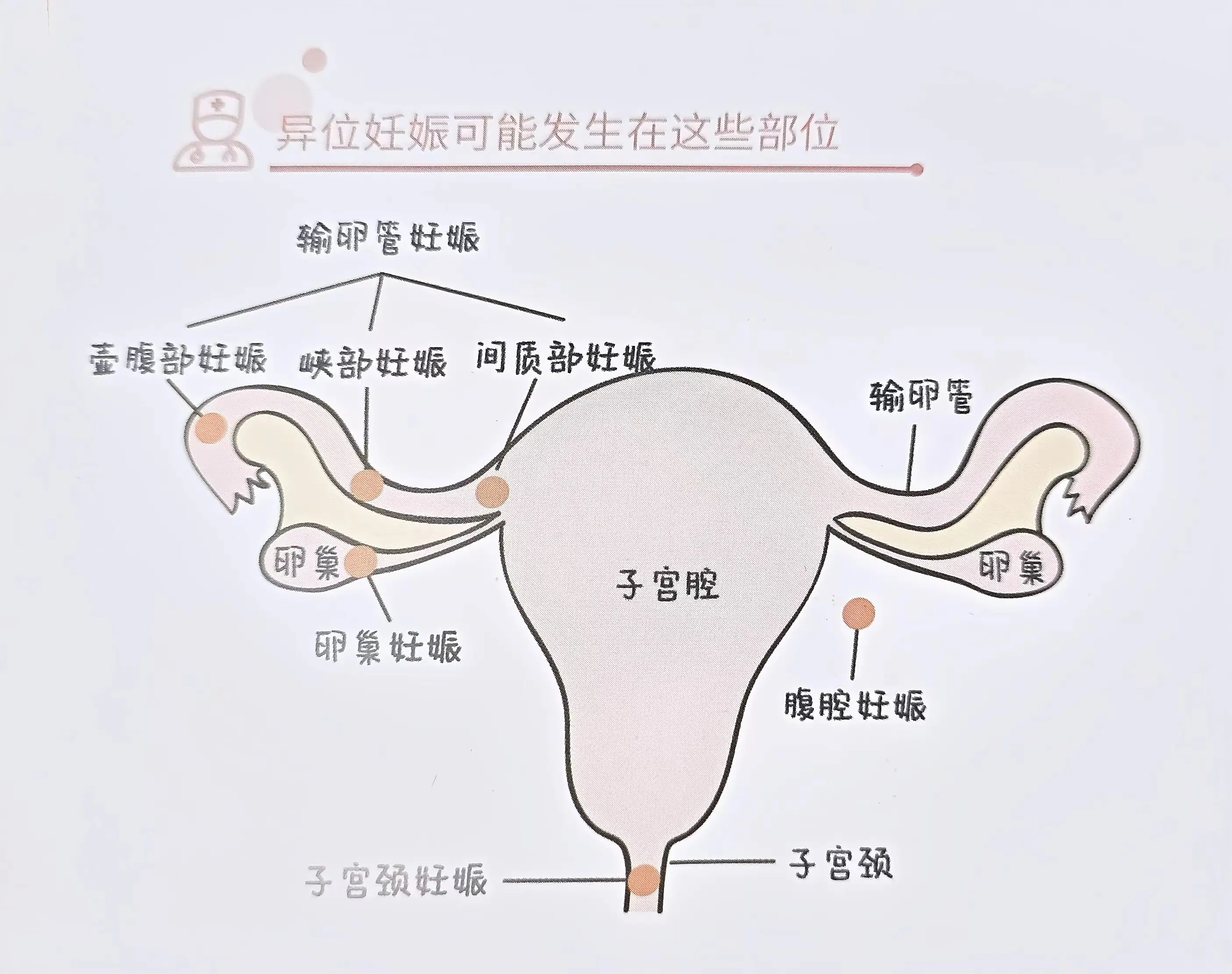 造成宫外孕原因