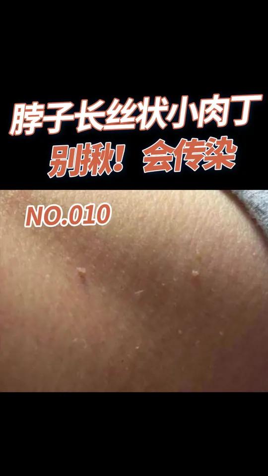 丝状疣是怎么形成的