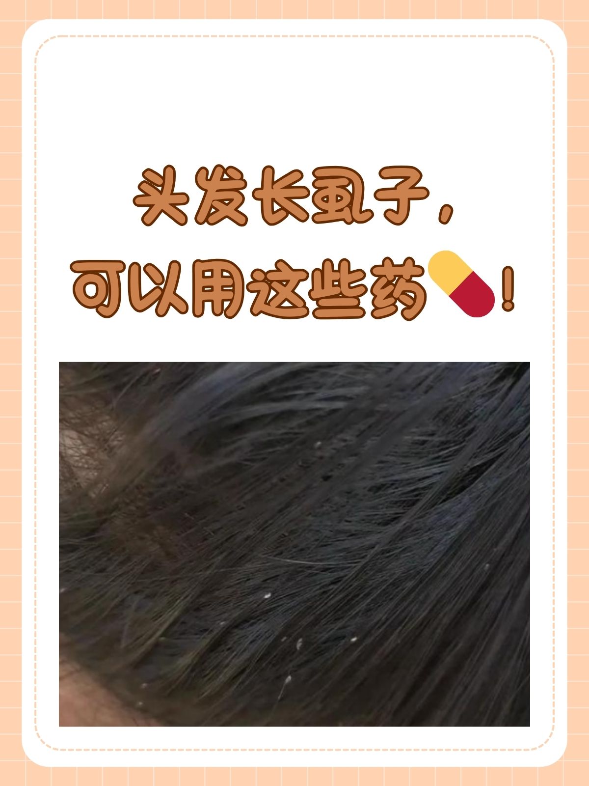 长了头虱,怎么彻底去除