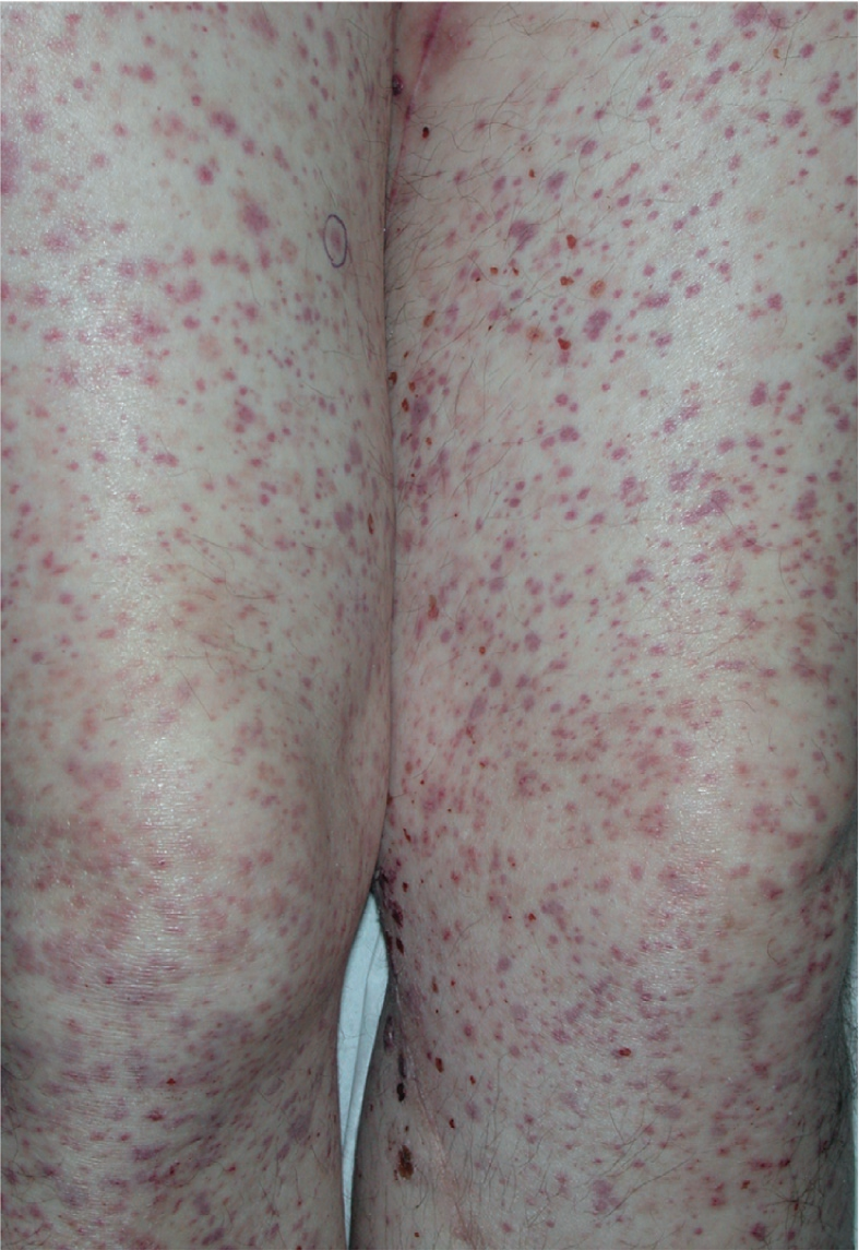 血管炎能治好吗