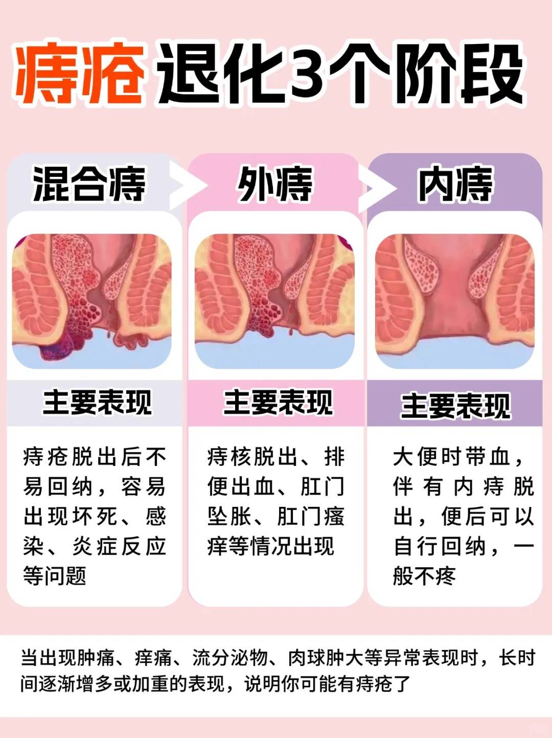 痔疮怎么治疗好