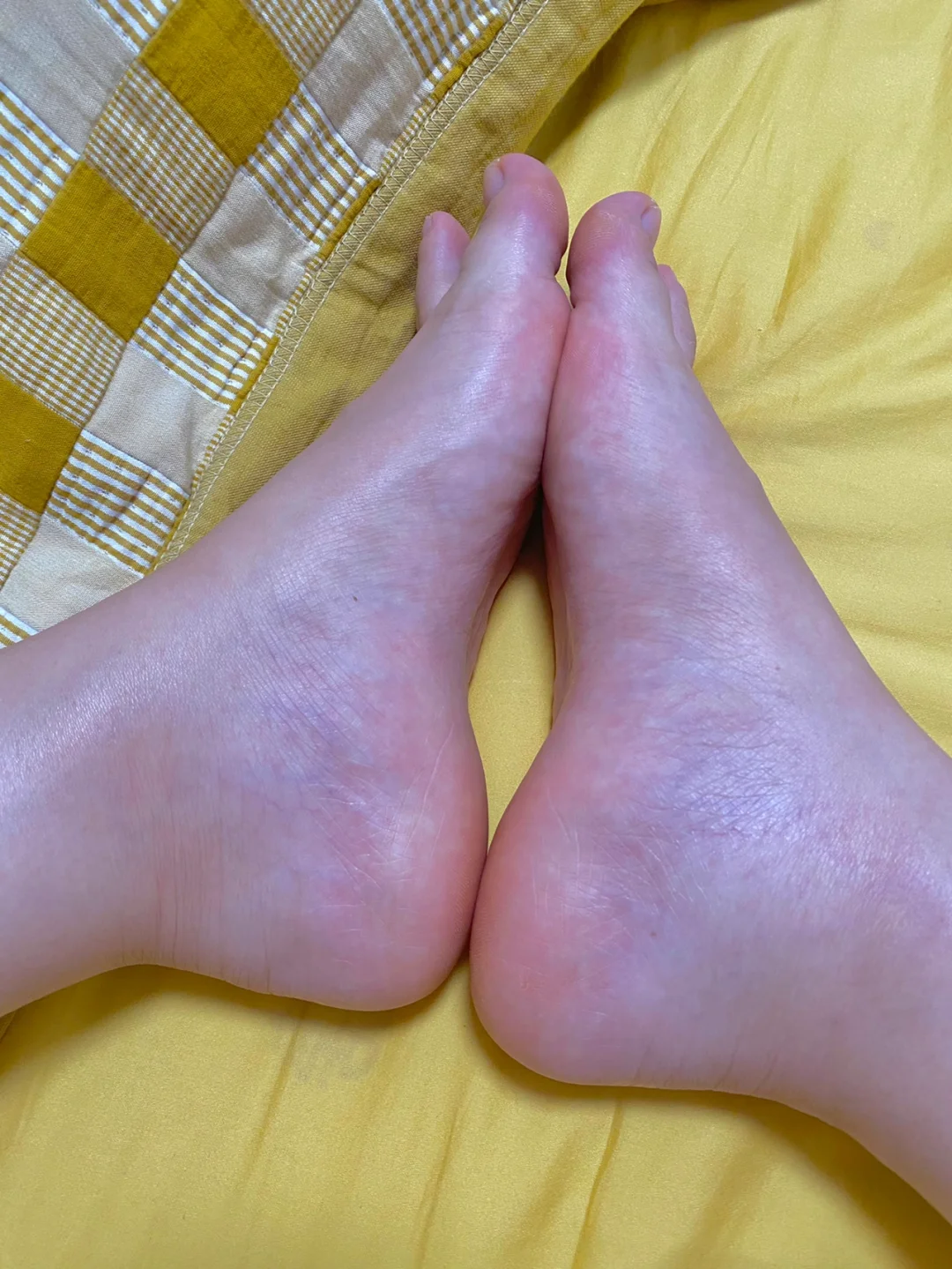 什么是水肿