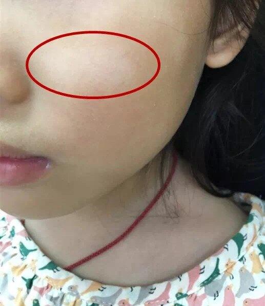 小孩脸上有白斑怎么回事