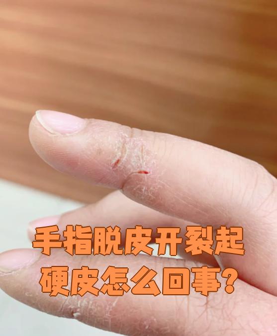 手指脱皮是怎么回事?
