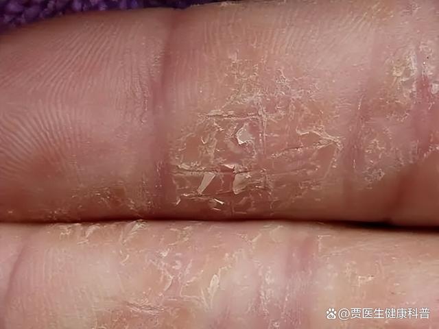 手指脱皮是怎么回事?