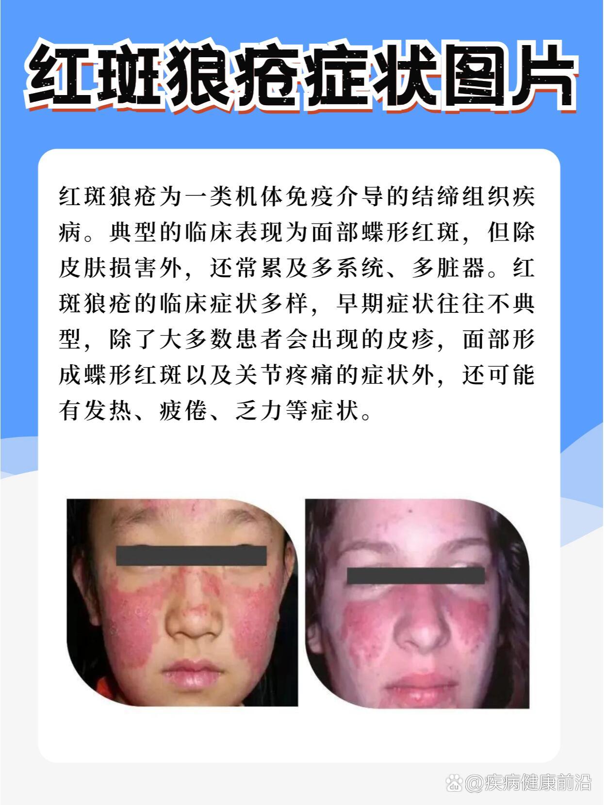什么是红斑狼疮?