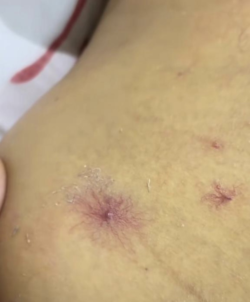 身上长红痣,是怎么回事?