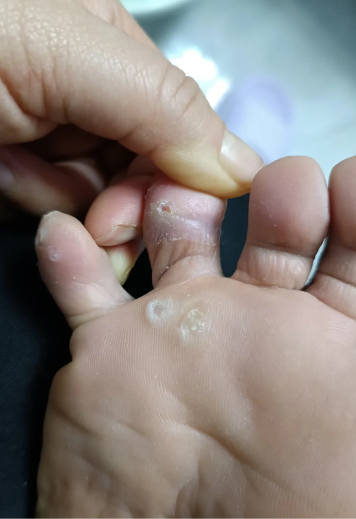 脚底长了一个硬包,是什么？按压会痛,不按