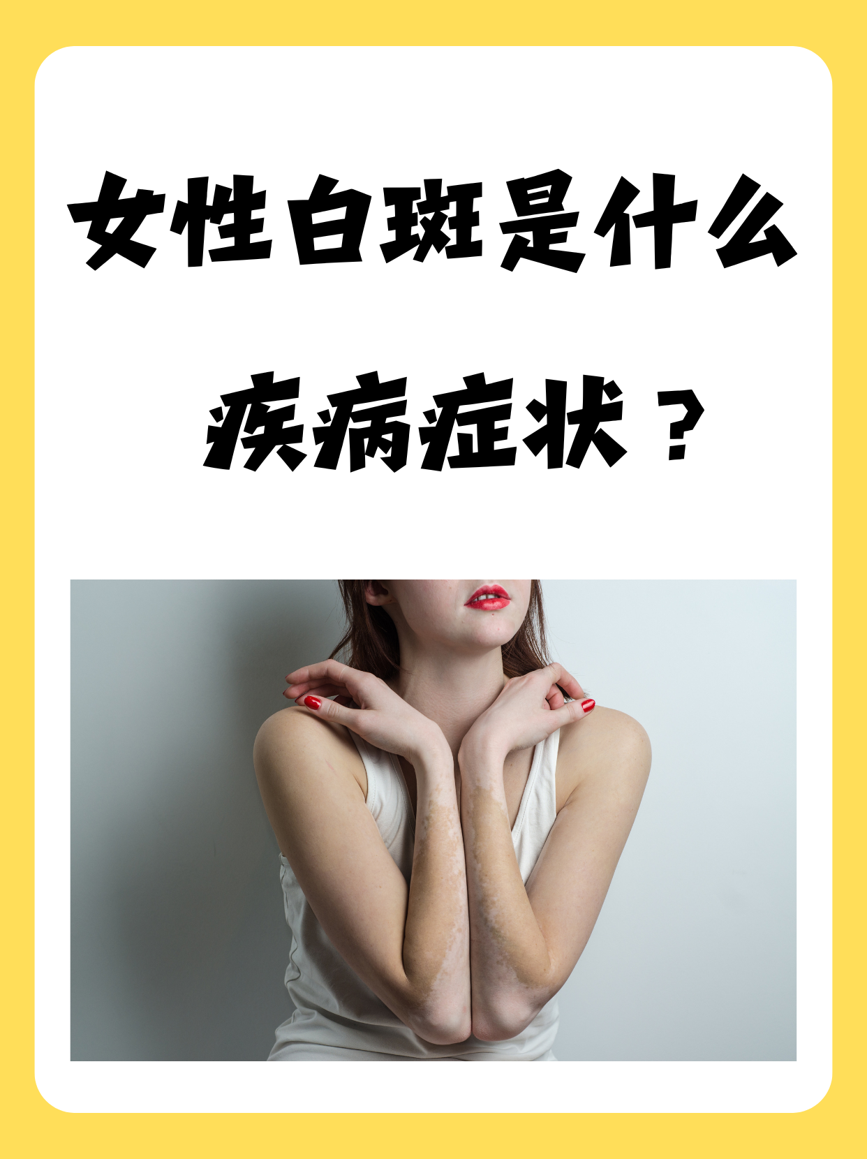 什么是白癜风病