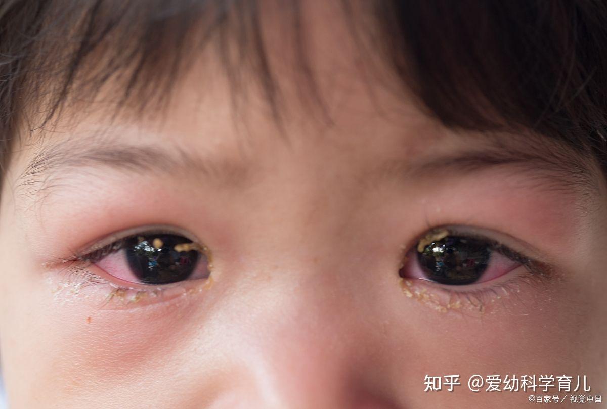 泪腺炎是什么症状