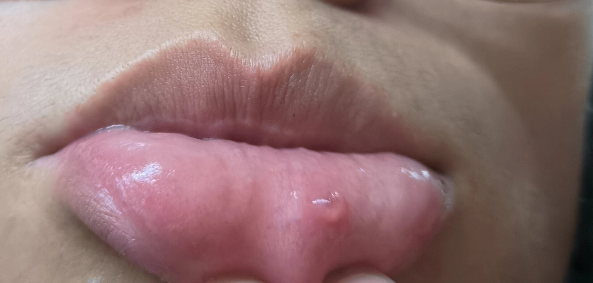 嘴唇上起小水泡,很小的