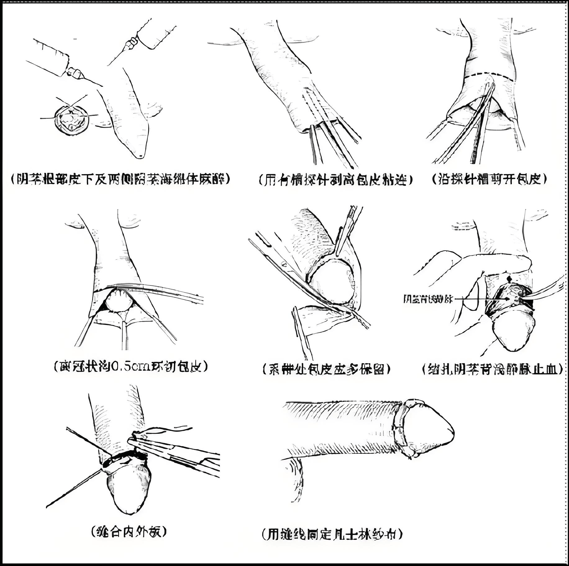 切包皮要多久