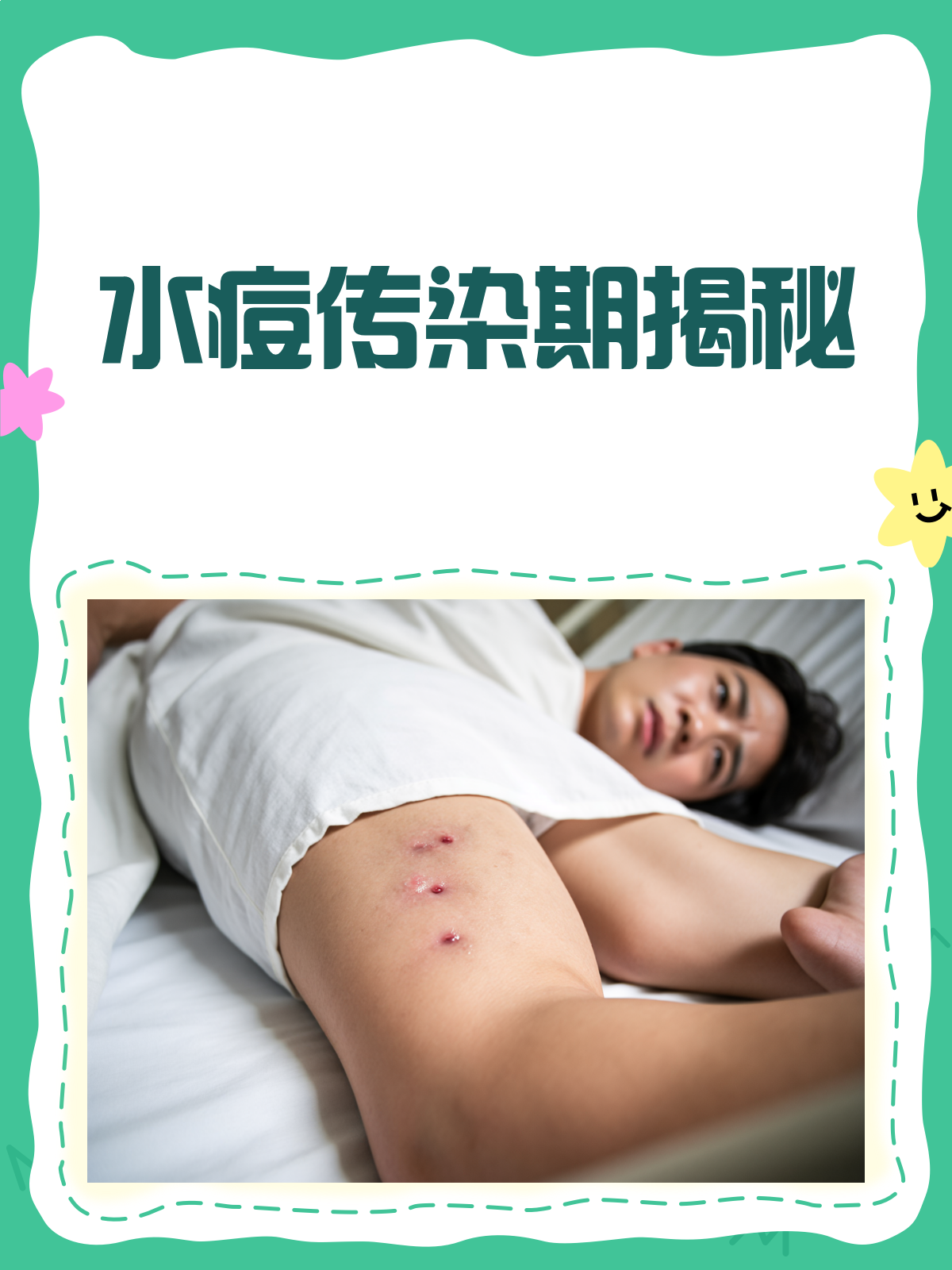 水痘传染期是多少天
