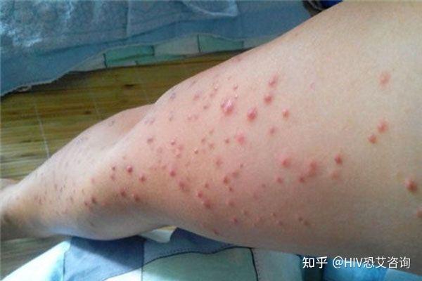 艾滋病必须有的症状是什么