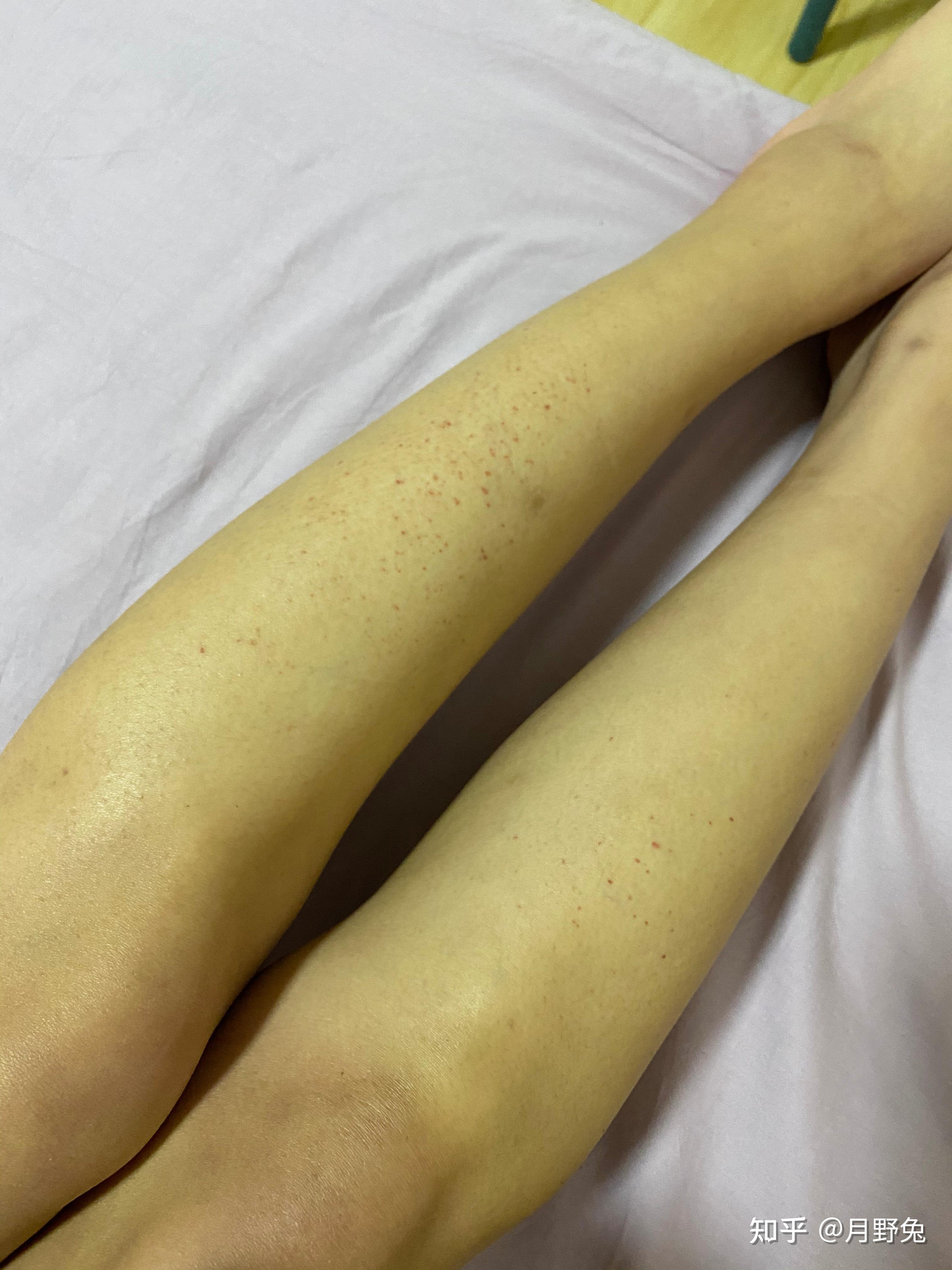 过敏性紫癜性肾炎