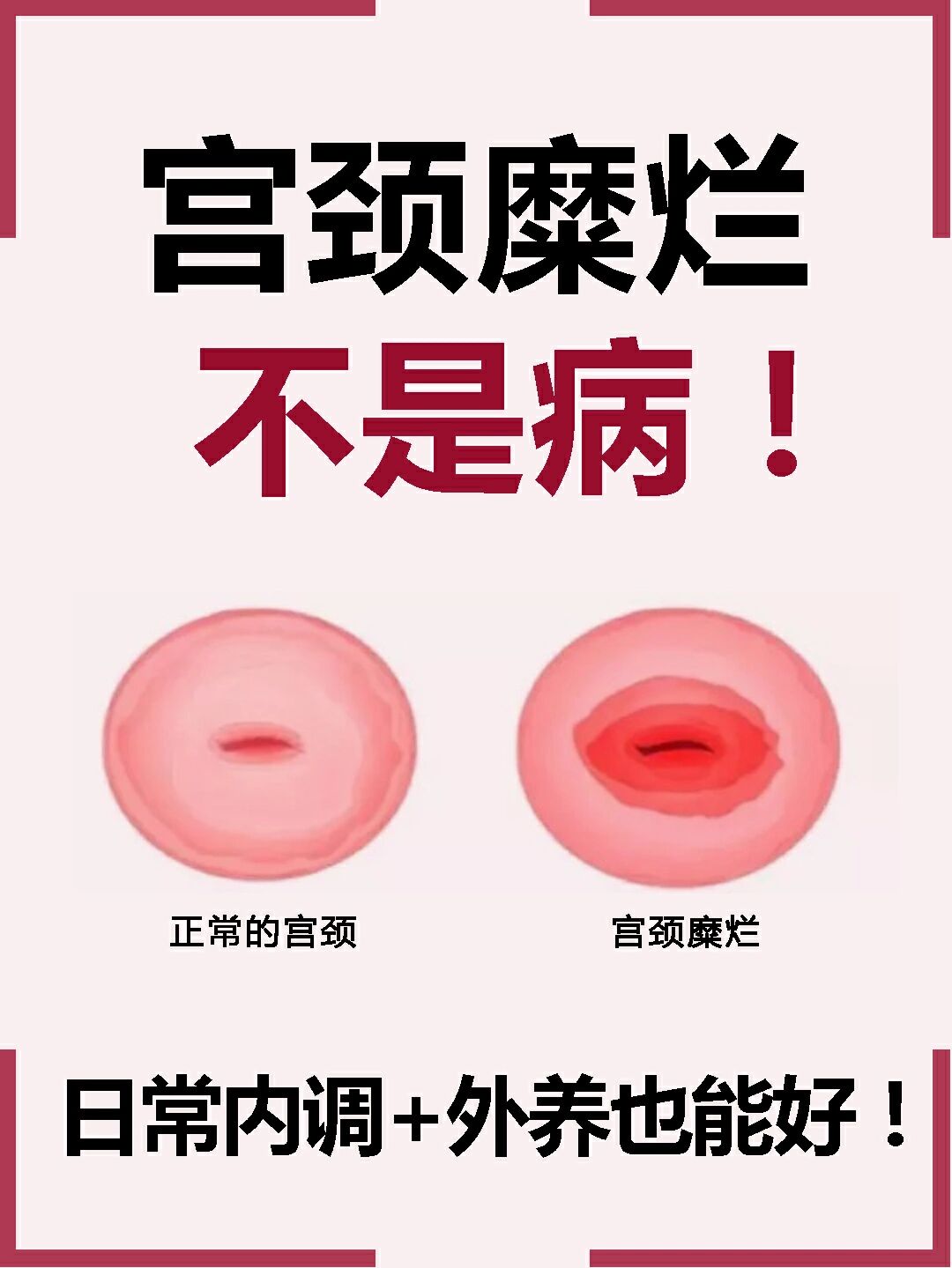 宫颈糜烂有哪些原因引起
