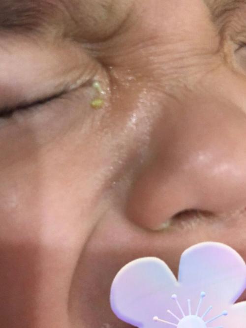 眼睛老出眼屎是怎么回事