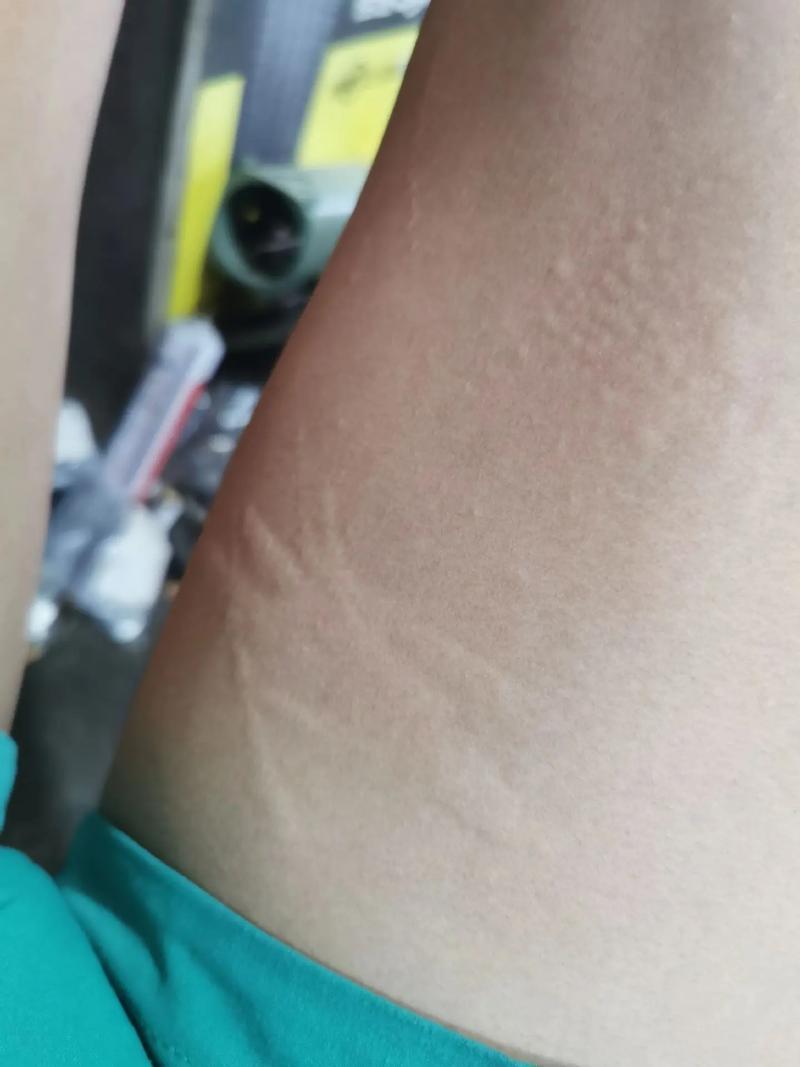 皮肤划痕症