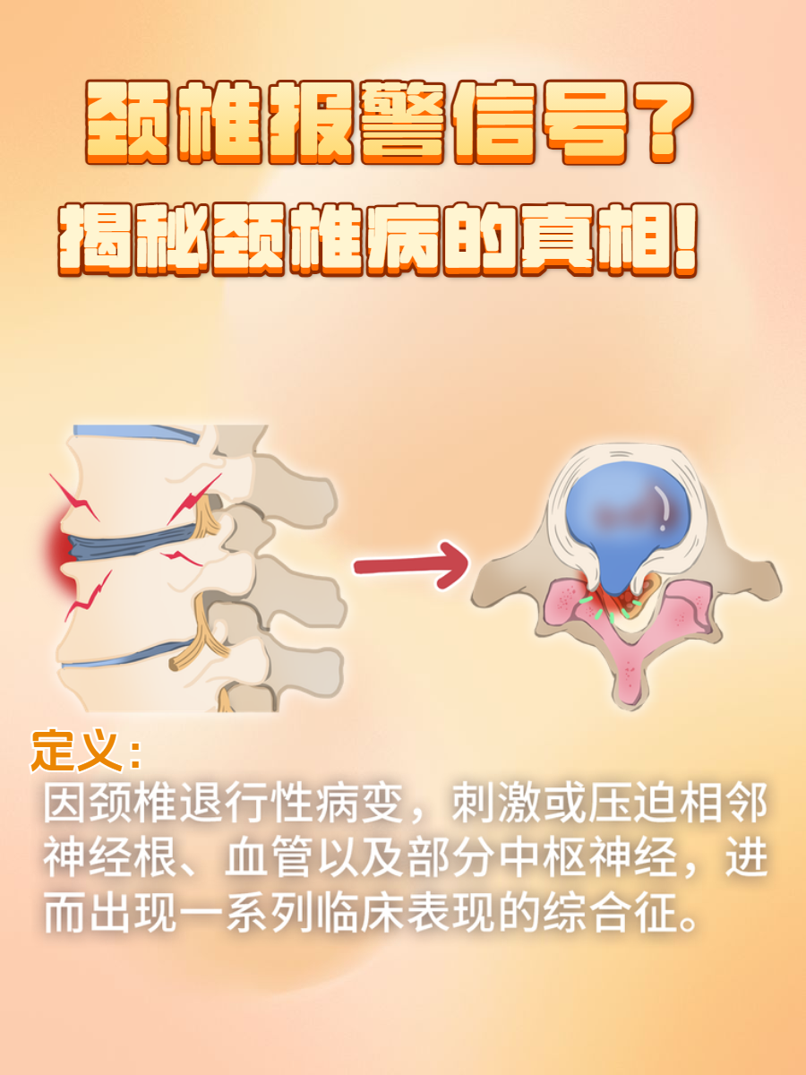 颈椎病会瘫痪吗