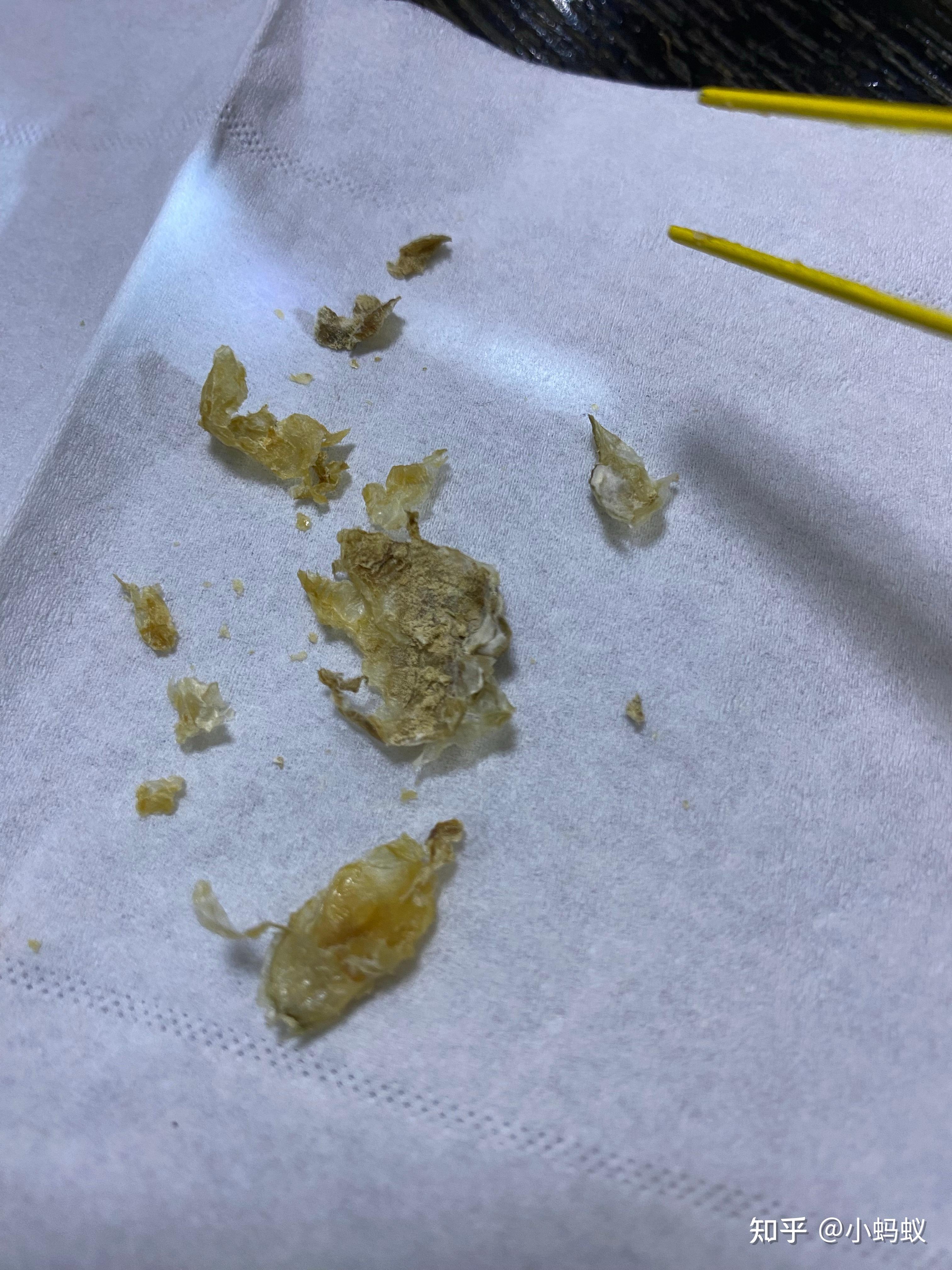 耳朵耳屎湿臭怎么回事