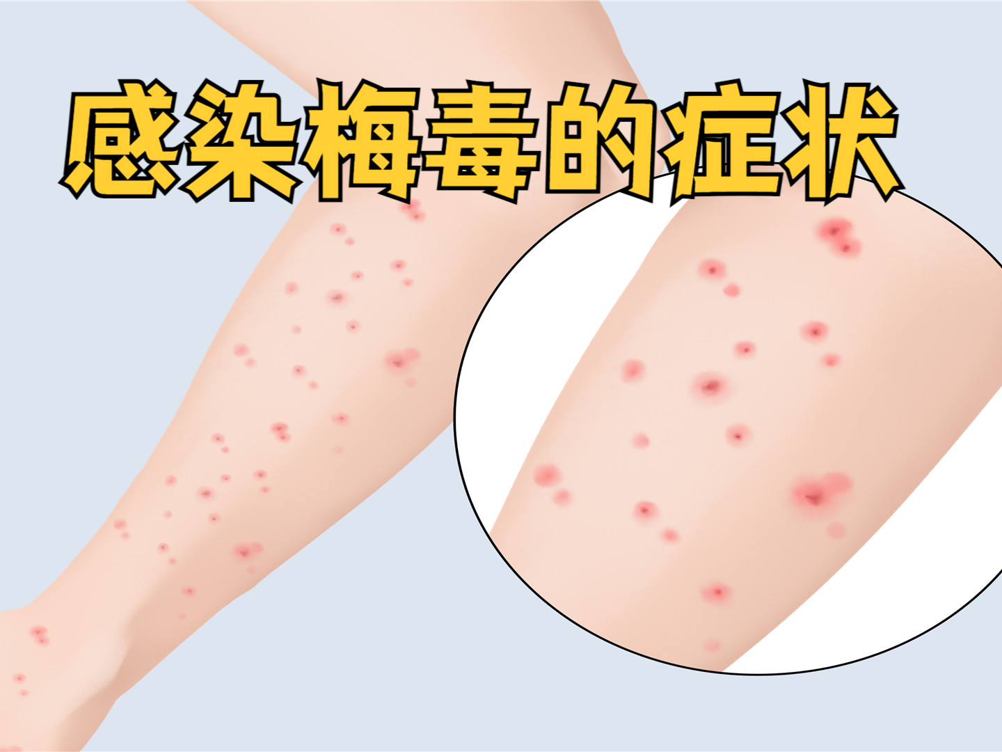 什么是霉毒?为什么会得霉毒