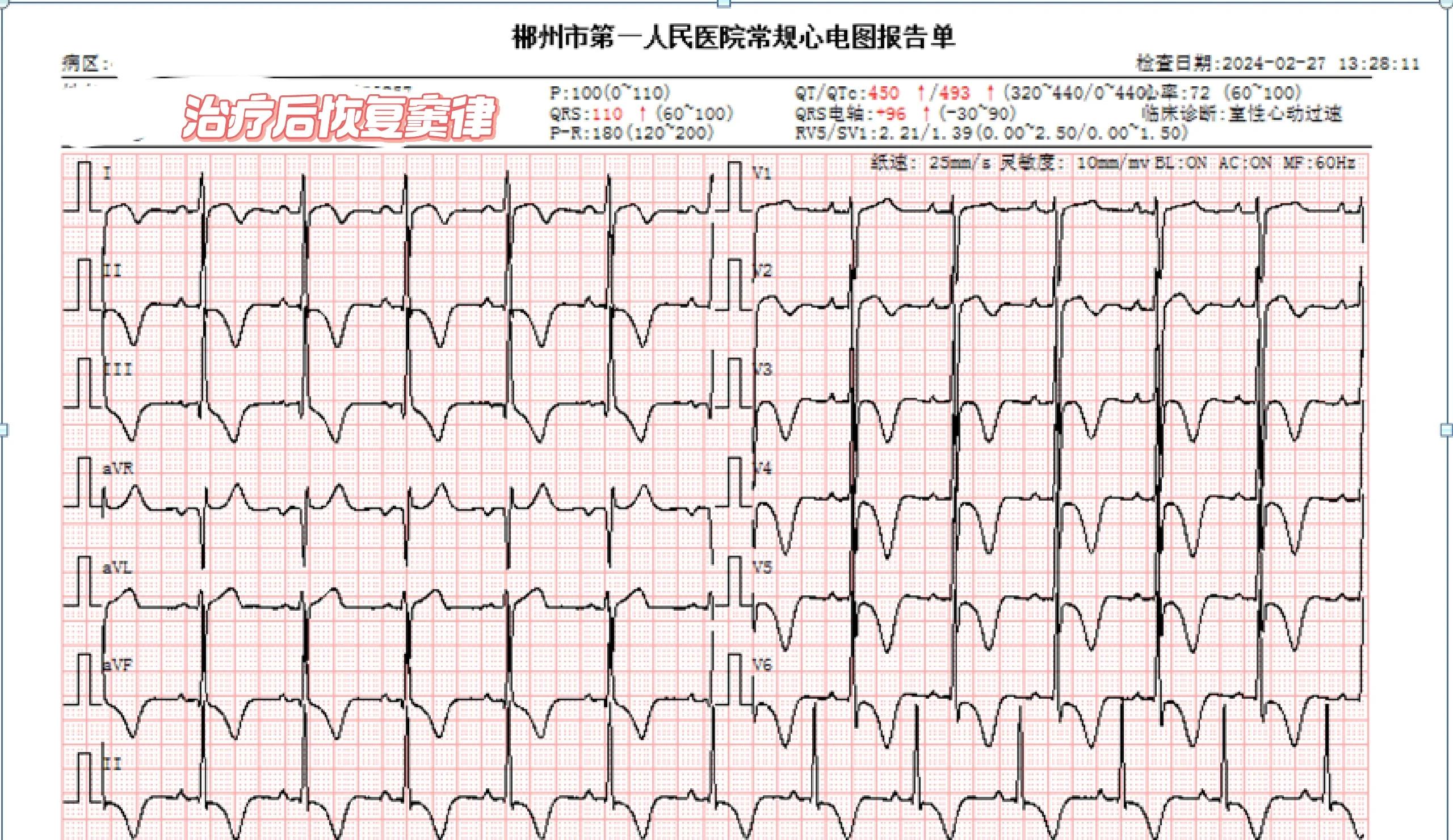 心电T波倒置是什么意思