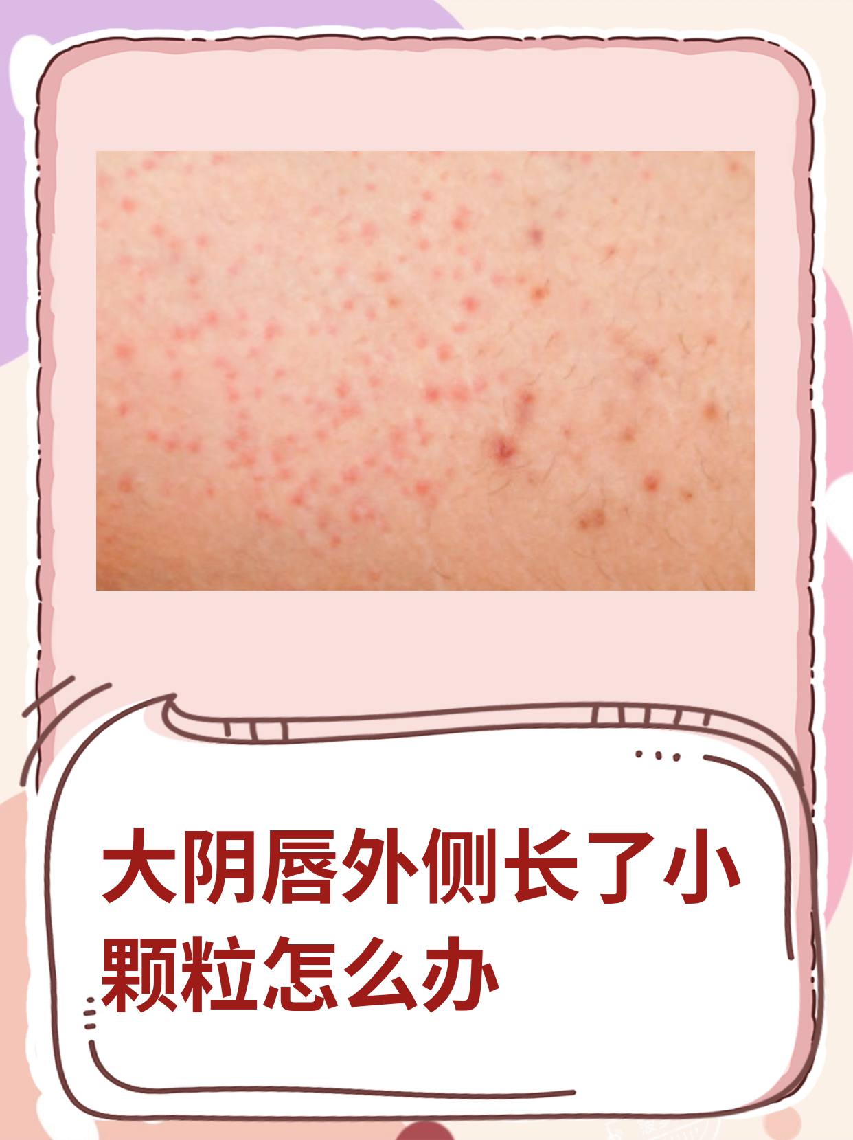 粉刺瘤是怎样形成的