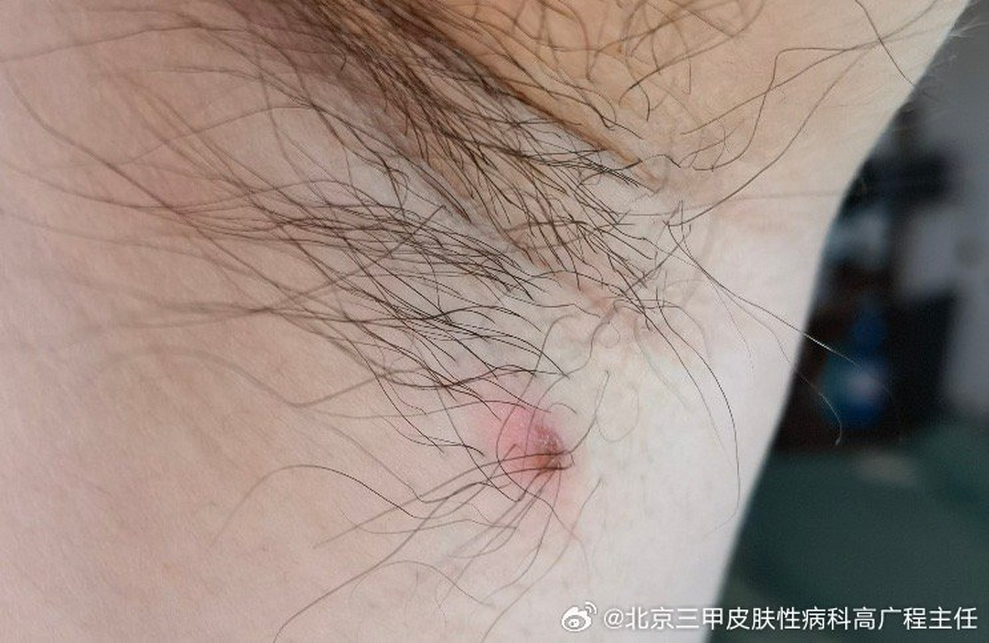 腋下长了个疙瘩很疼,怎么办