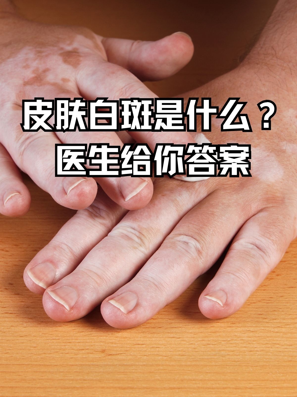 什么是白癜风?