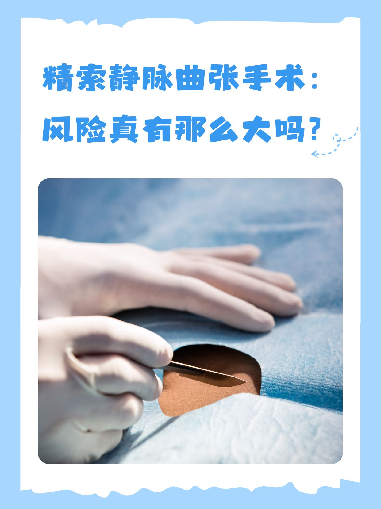 精索静脉曲张怎么办