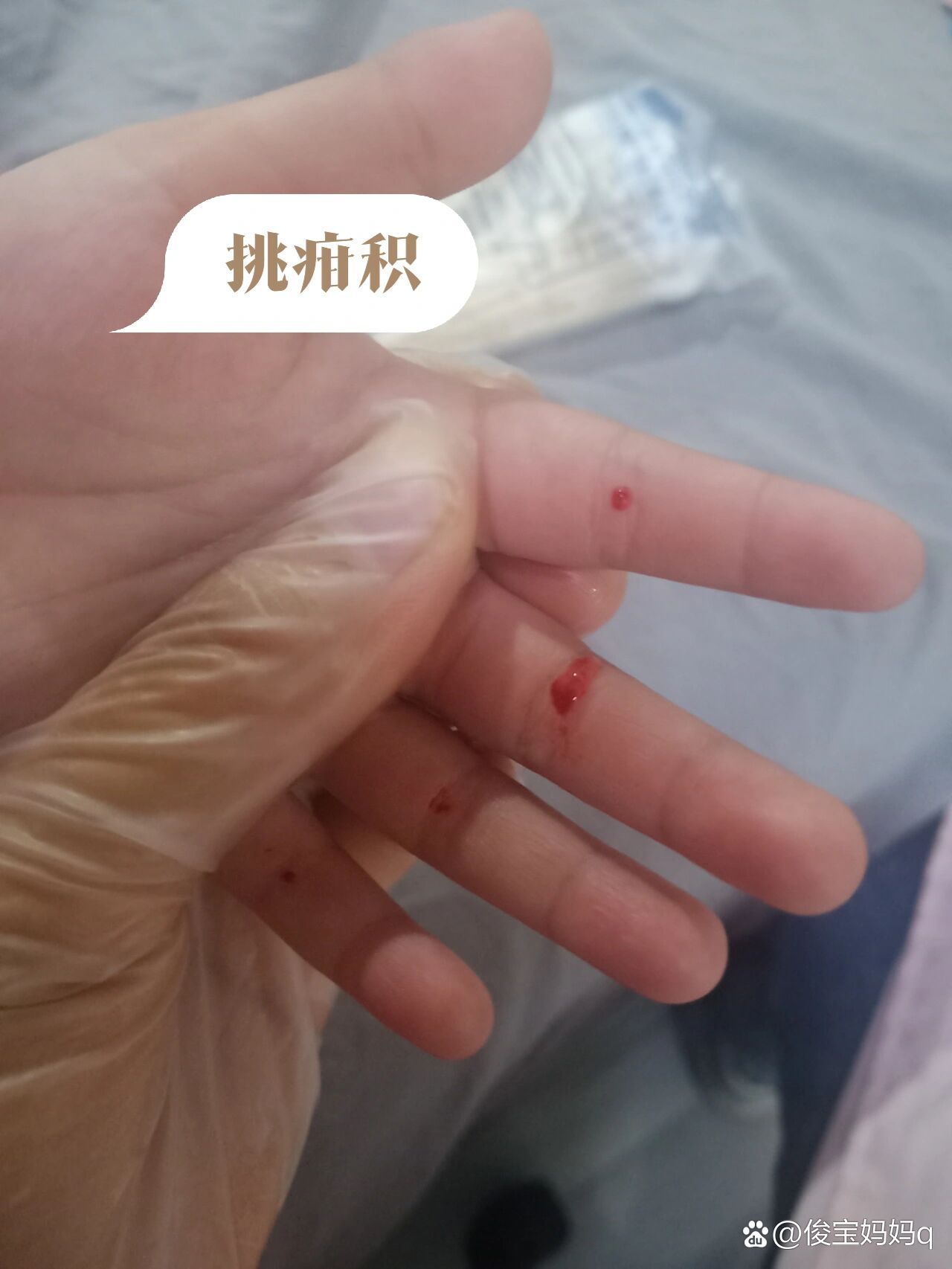 小儿疳积是什么病?有什么症状?