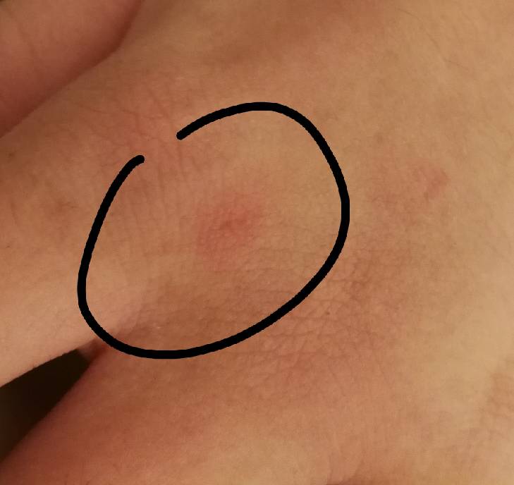 被狗抓了有红印子没出血