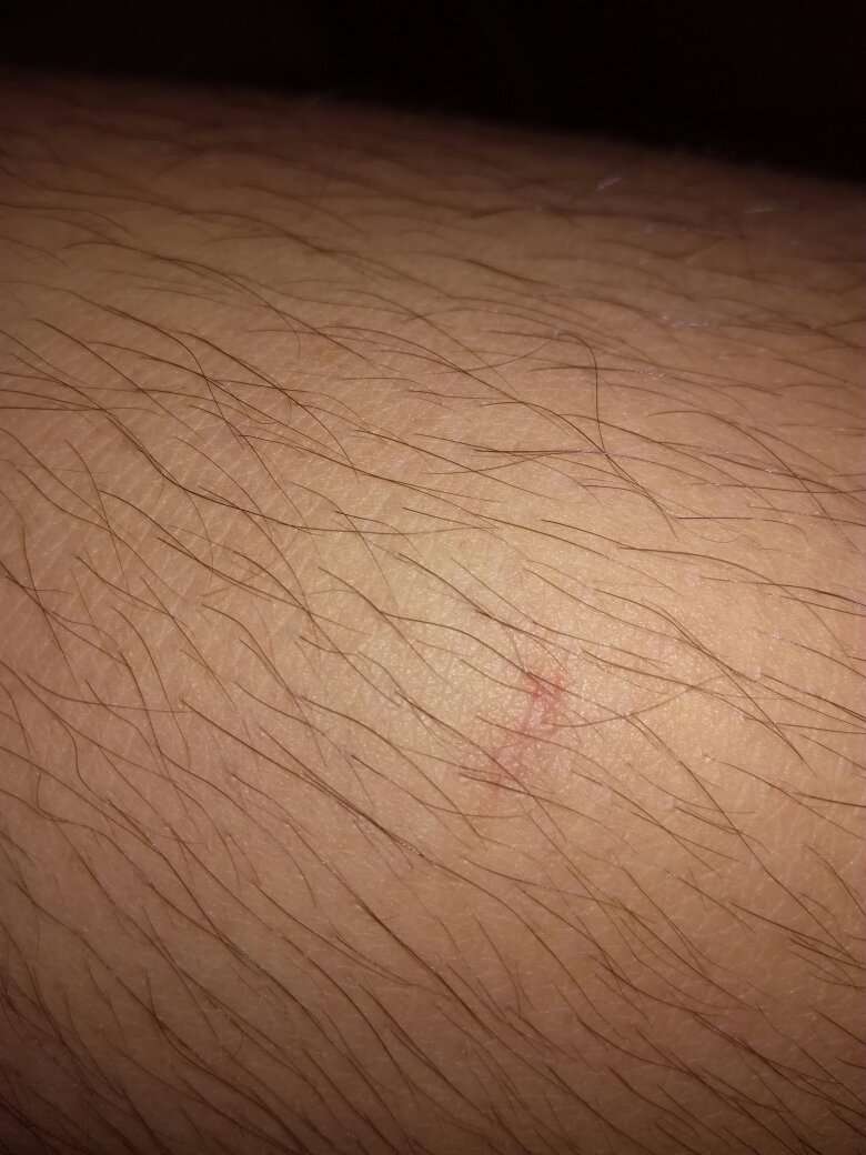 被狗抓了有红印子没出血