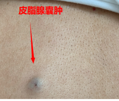 多发性皮脂腺囊肿的病因