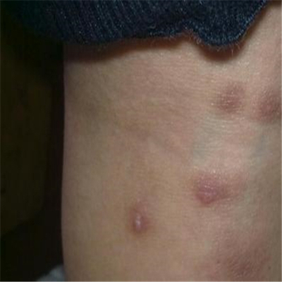 性病有什么症状呢