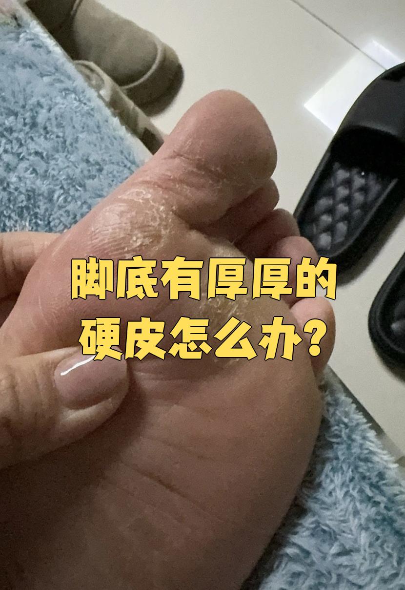 脚底硬皮怎么处理?3招轻松搞定!