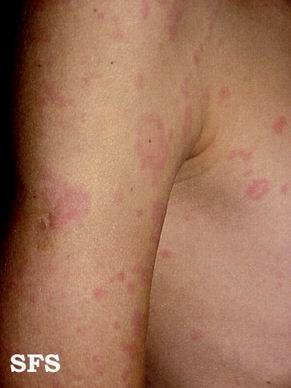 丘疹性荨麻疹是艾滋病吗