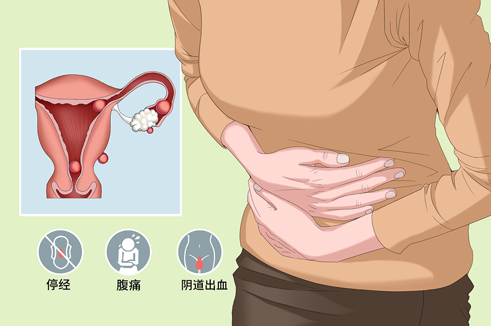 宫外孕是怎么造成的?