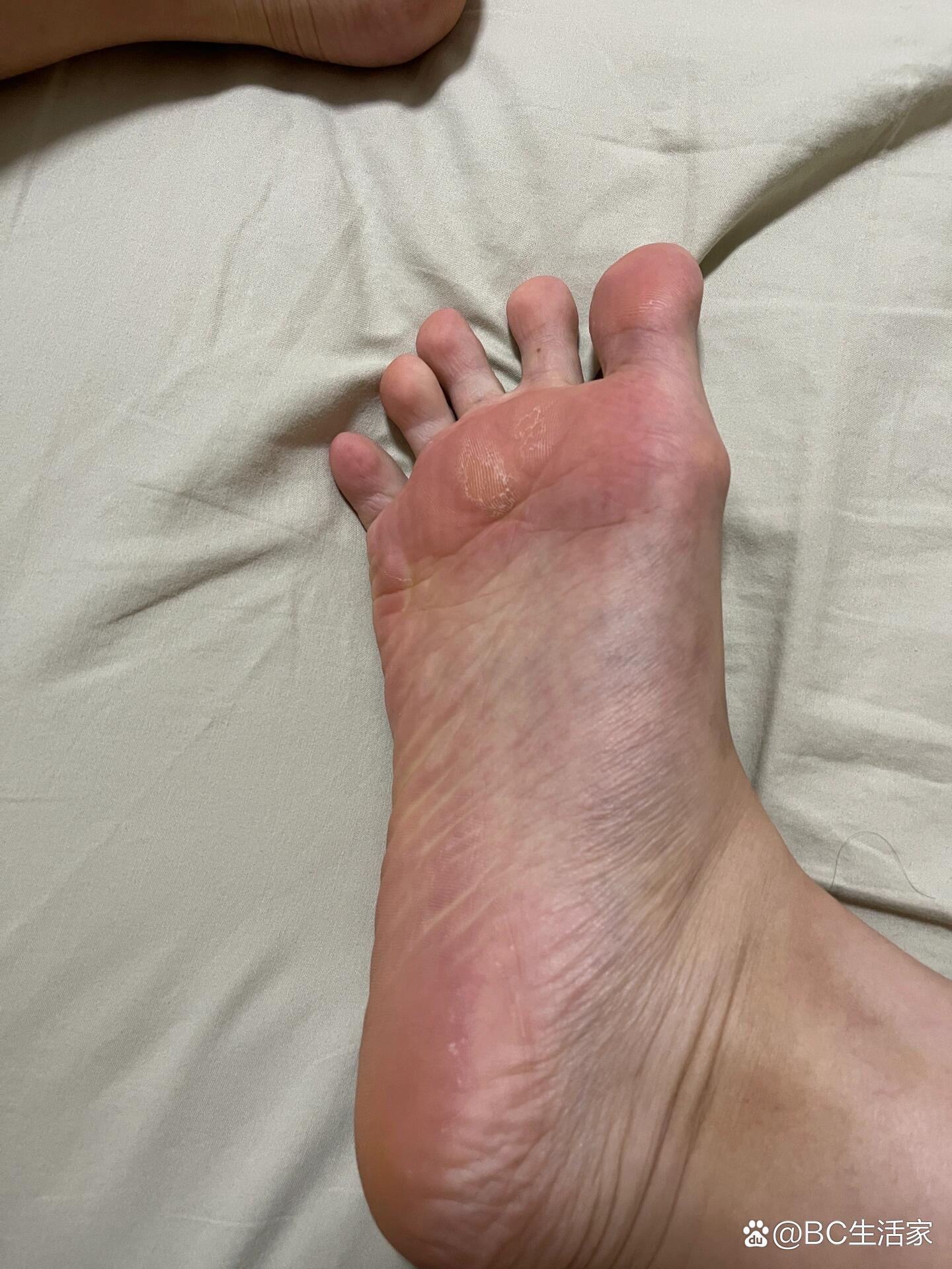 脚底脱皮缺什么维生素