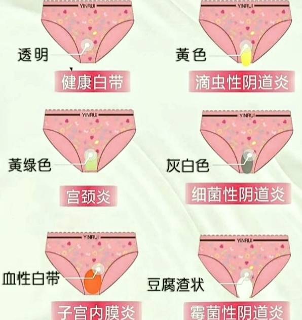 先天性无阴道的症状表现有哪