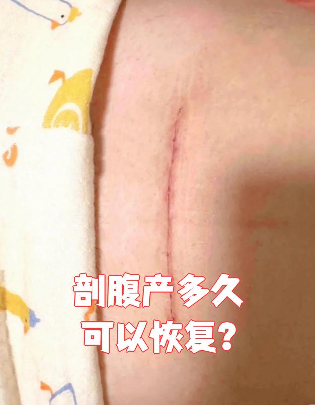 剖腹产后多久能恢复,