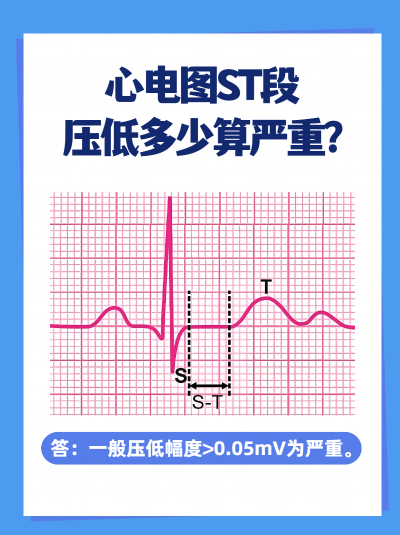 心电图t波低平是什么意思