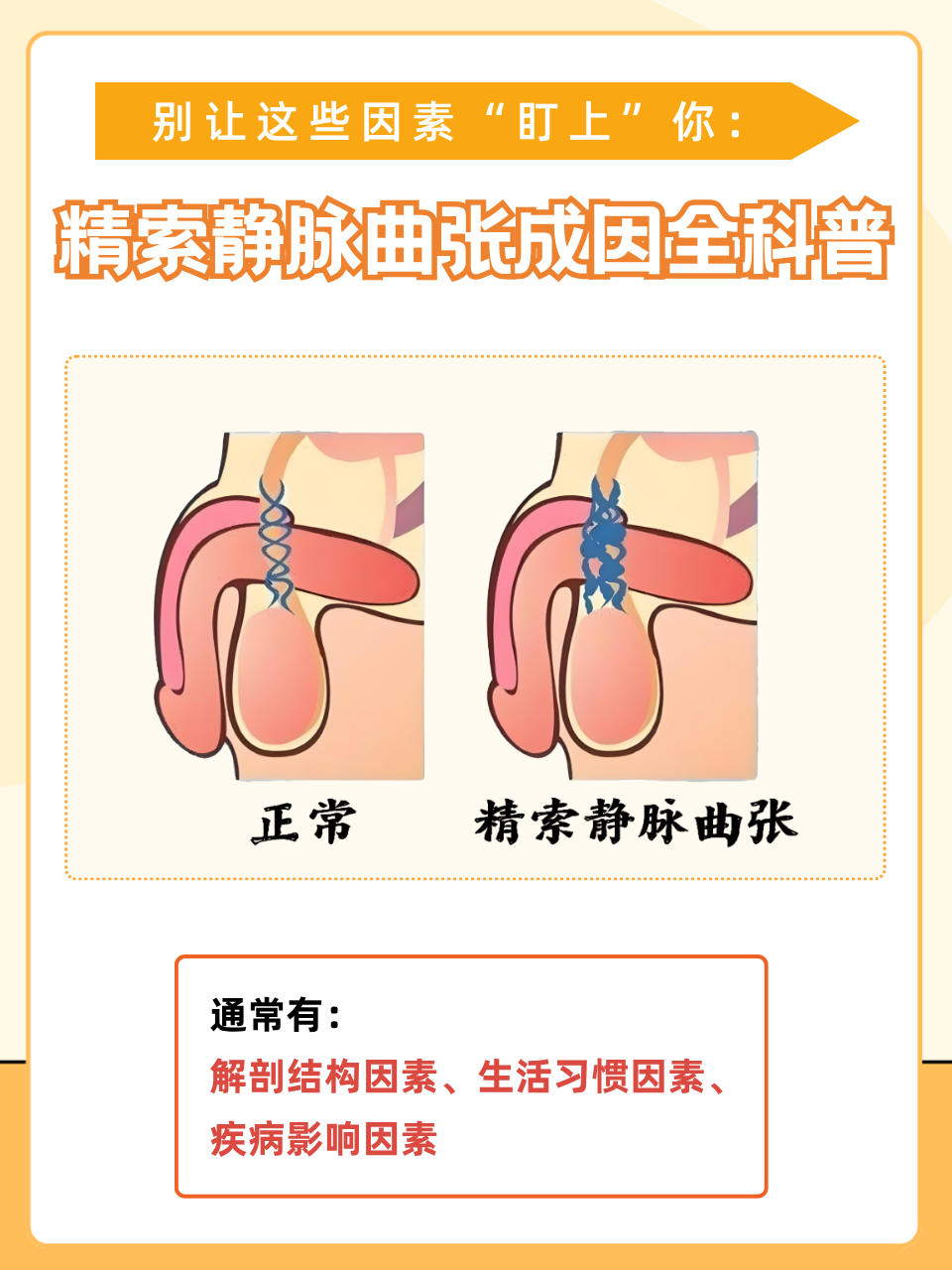 精索静脉曲张什么原因引起的