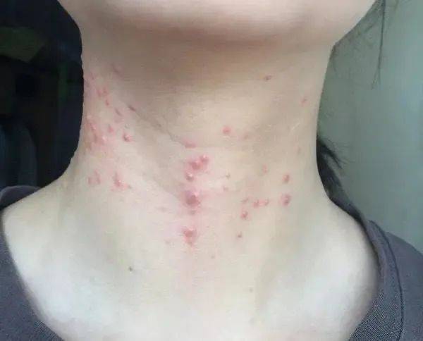 内分泌失调症状