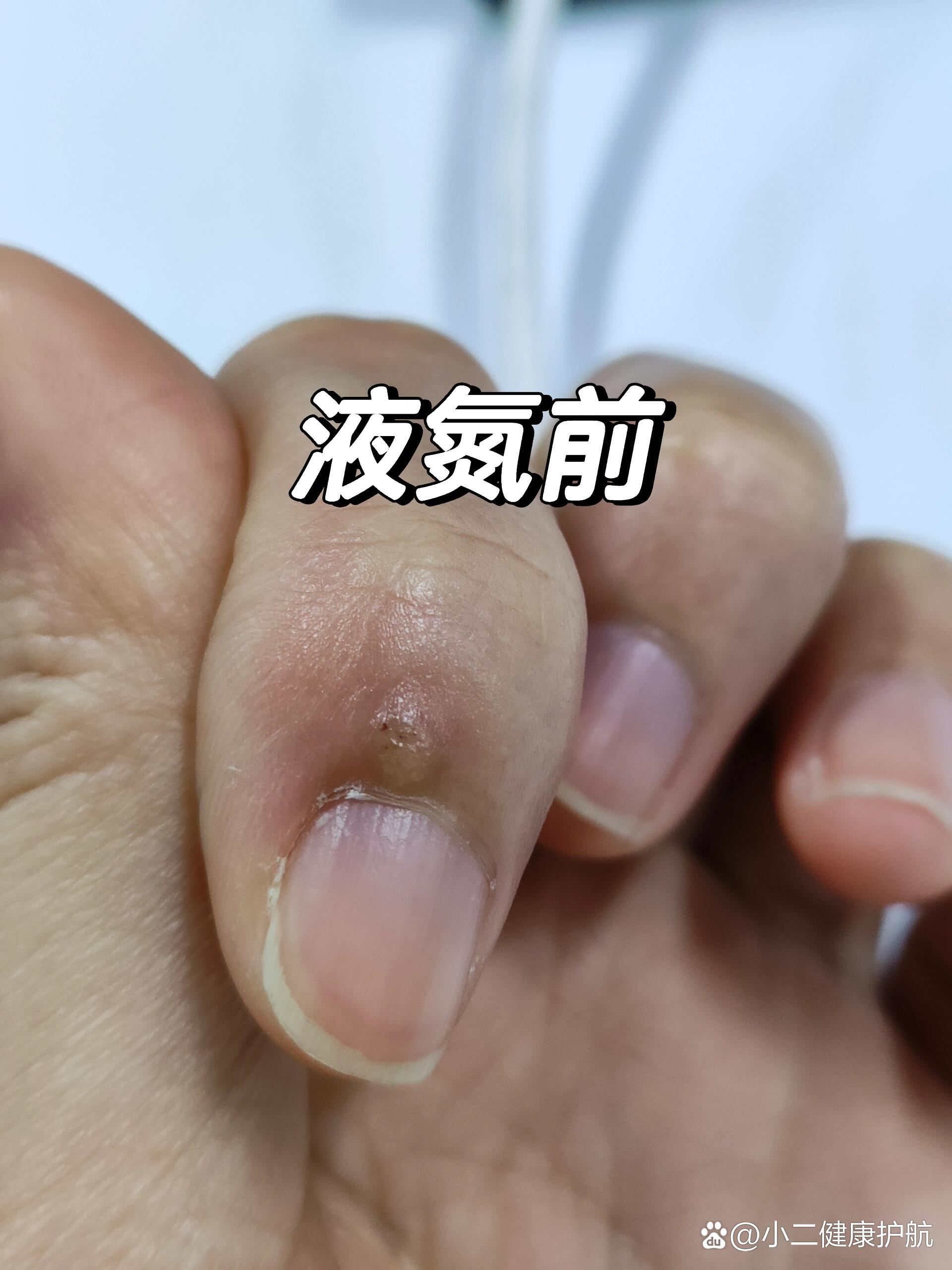 治疗寻常疣最好方法