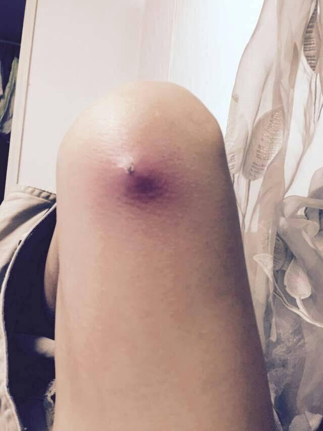 臀部长了一个肉疙瘩,硬硬的
