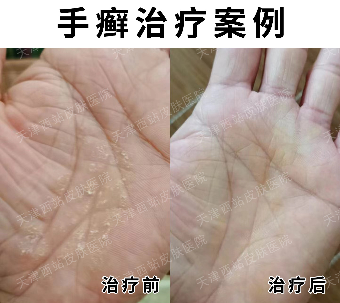 脚气会传染到手上吗?