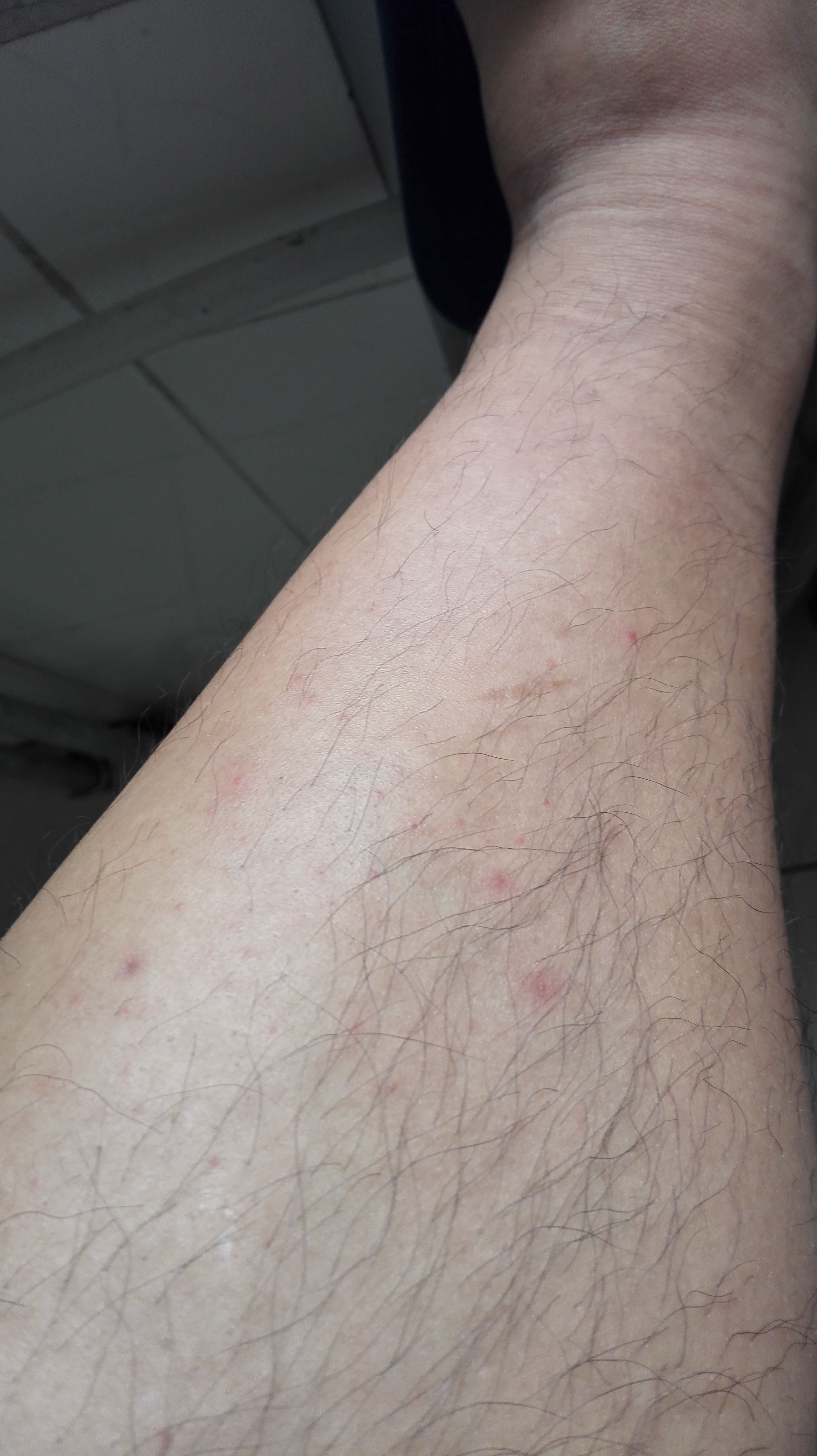 大腿上有红点点不痛不痒