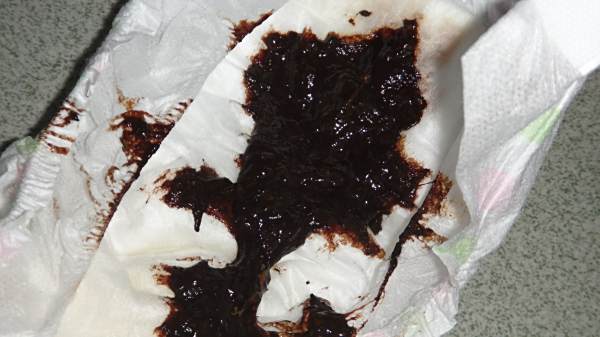 拉大便是黑色的,怎么回事