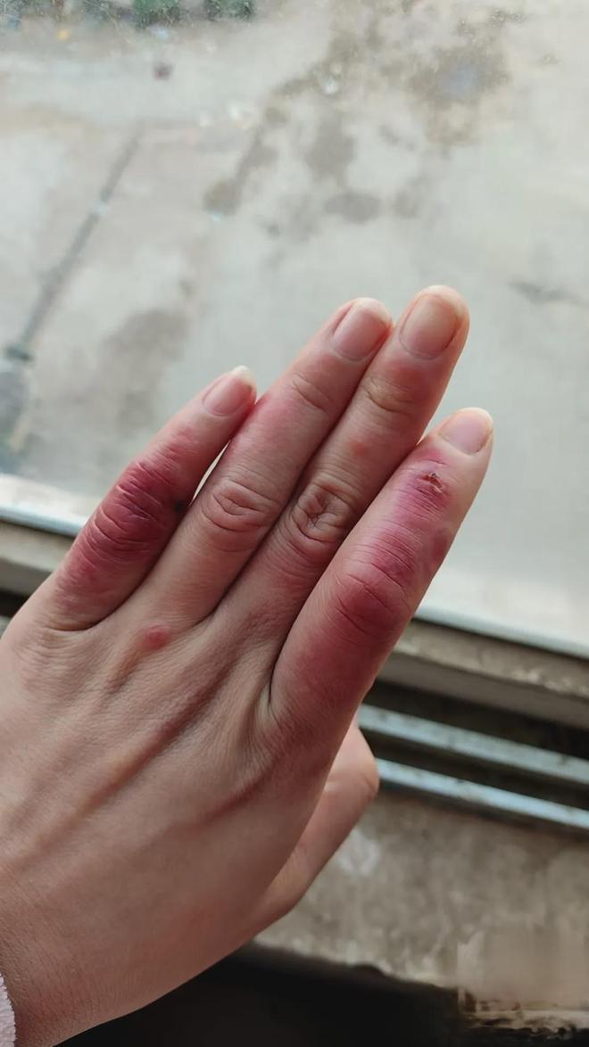 冻疮的治疗方法